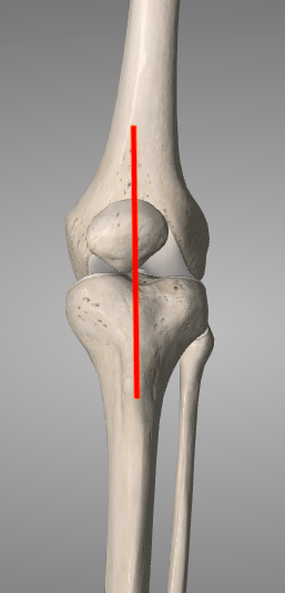 Total Knee Replacement